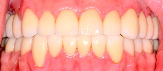 Healthy smile after full mouth reconstruction