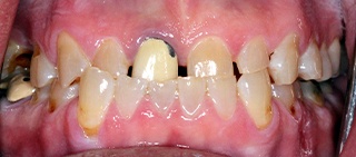 Severely decayed and damaged smile before full mouth recontsrtuction