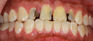 Front teeth with severe tooth decay