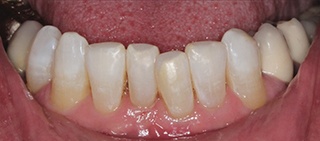 Gorgeous smile after conservative cosmetic dentistry treatment