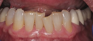 Misaligned worn and discolored teeth