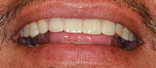 Patient with flawlessly restored smile after tooth replacement