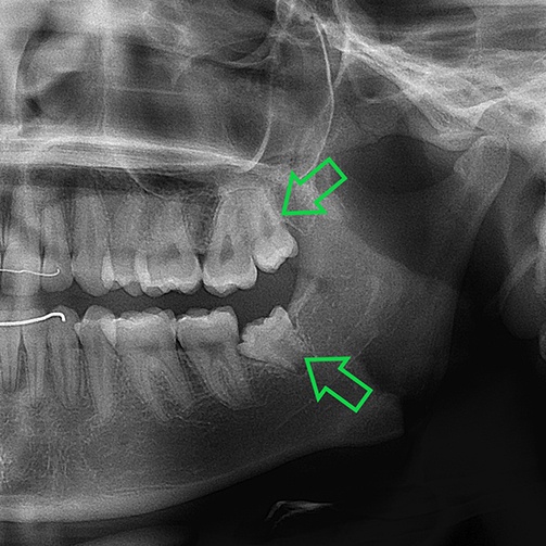 X-ray of impacted teeth