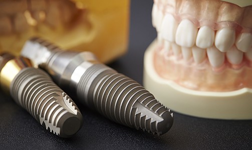 Two dental implant posts and smile model