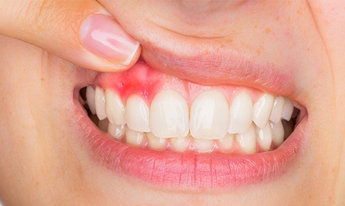 Closeup of smile with red and inflamed gum tissue