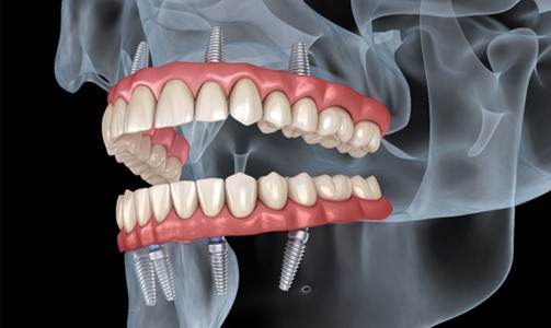 Illustration of All-on-4 for top and bottom dental arches