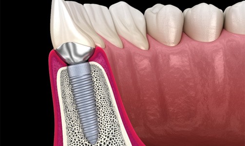 Illustration of traditional dental implant in lower arch