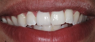 Smile after dental implant tooth replacement