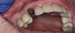 Smile with missing tooth after dental implant placement
