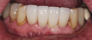 Smile after dental implant tooth replacement