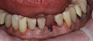 Smile with missing bottom tooth with a dental implant post in position
