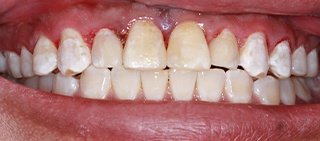 Smile after tooth-colored filling restorations