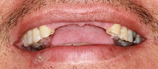 Patient with several missing top front teeth
