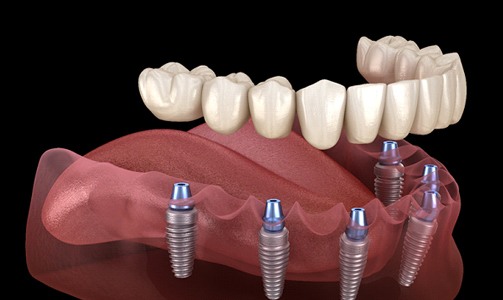 Implant dentures in Idaho Falls
