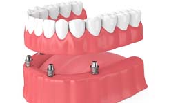 four implants supporting a denture