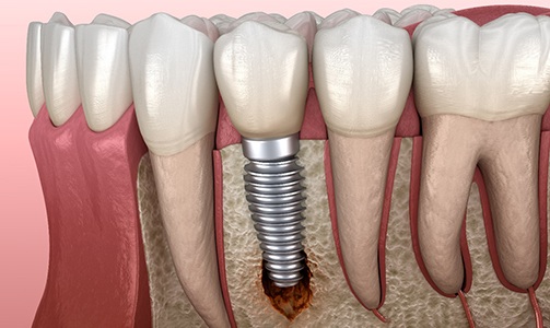 Bone loss causing dental implant failure in Idaho Falls, ID