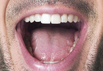 View of top row of teeth with open mouth