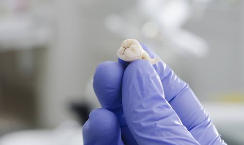 Hand holding an extracted tooth