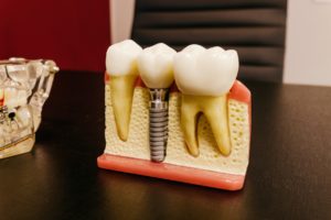 Dental implant model on a desk